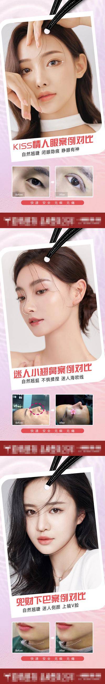【南门网dcpsd.com】海报 医美 整形 案例 对比 眼部 鼻部 下巴