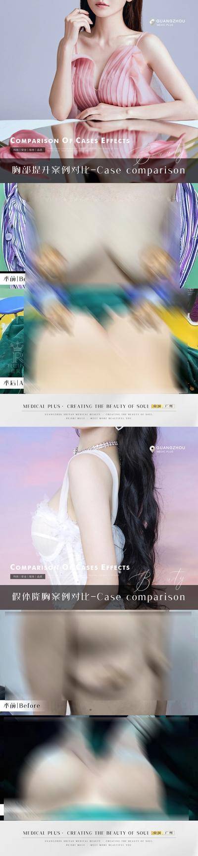 【南门网dcpsd.com】海报 医美 整形 案例 对比 人物 假体丰胸 隆胸 胸部 提升 系列