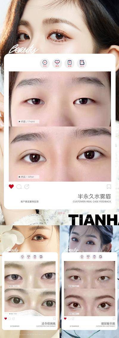 【南门网dcpsd.com】海报 医美 整形 美业 美容 案例对比 人物 双眼皮 抗衰 美女