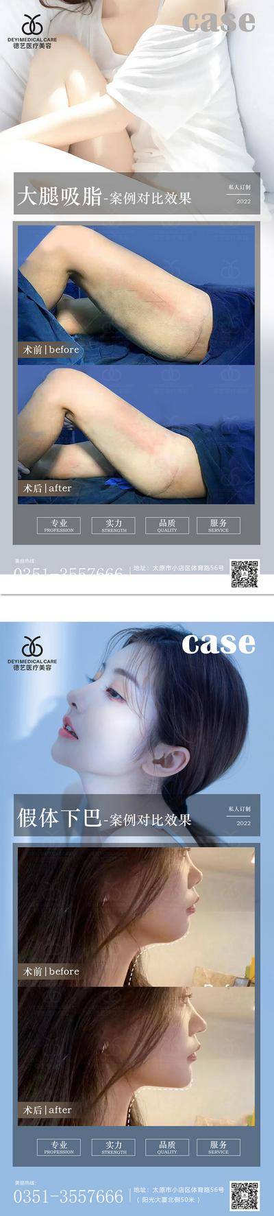 【南门网dcpsd.com】海报 医美 案例 吸脂 下巴 对比图