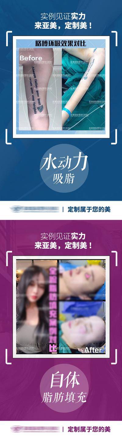 【南门网dcpsd.com】海报 医美 整形 案例 对比 人物 美眼 眼睛 假体 下巴