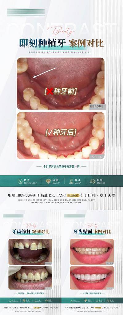 【南门网dcpsd.com】海报 口腔 医美 案例 对比 牙齿 补牙 正畸 种植牙