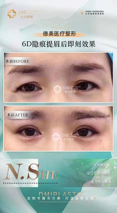 【南门网dcpsd.com】海报 医美 案例图 对比 提眉 切眉