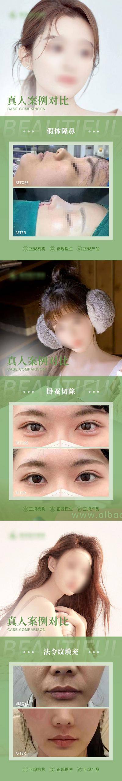 【南门网dcpsd.com】海报 医美 整形 卧蚕 填充 美眼 模特 蝴蝶 案例 对比