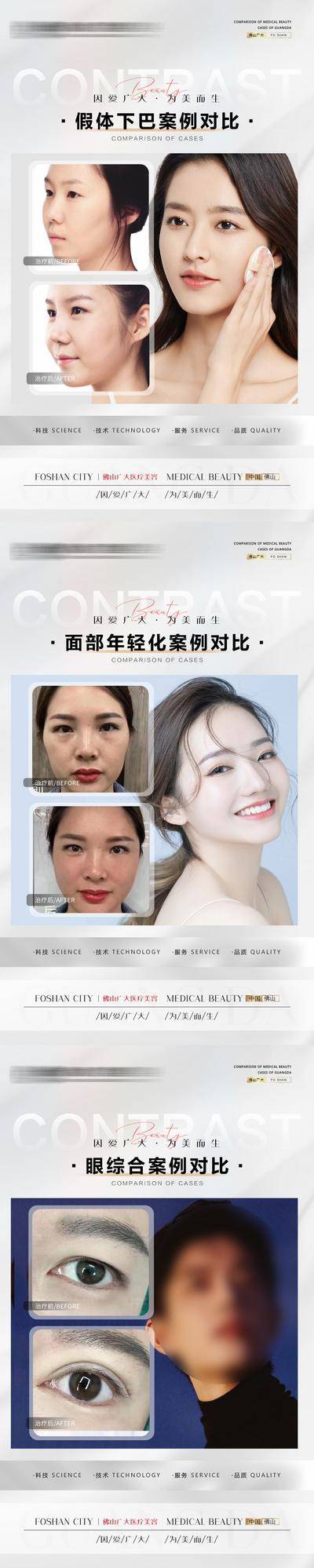 【南门网dcpsd.com】海报 医美 整形 案例 对比 人物 假体下巴 面部 年轻化 眼综合 双眼皮