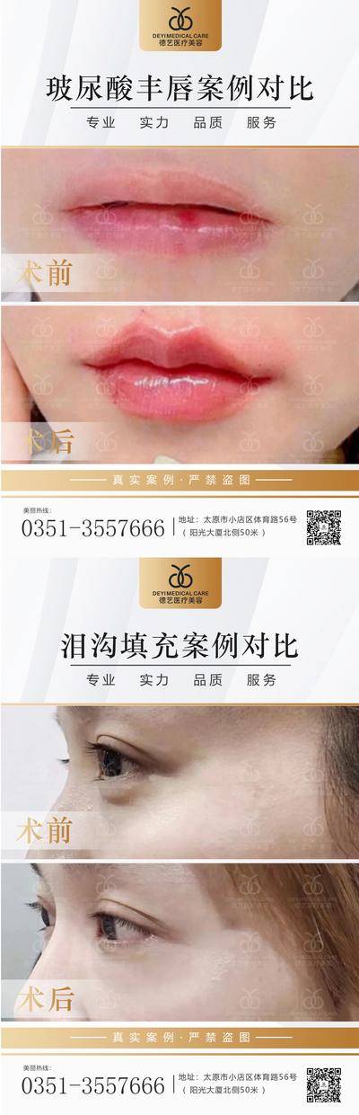 【南门网dcpsd.com】海报 医美 整形 案例 对比图 泪沟 丰唇