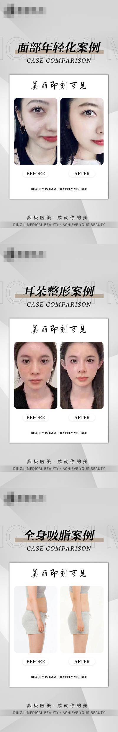 【南门网dcpsd.com】广告 海报 医美 案例 对比 整形