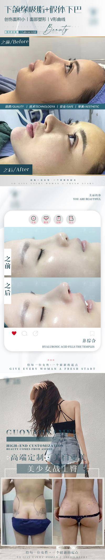 【南门网dcpsd.com】海报 医美 整形 美容 吸脂 鼻综合 案例 对比 系列