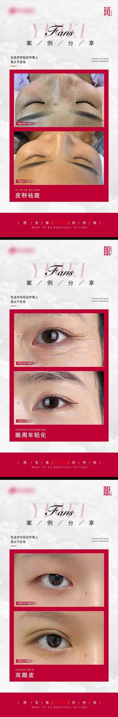 【南门网dcpsd.com】海报 医美 整形 皮秒祛斑 眼周年轻化 双眼皮 案例 对比