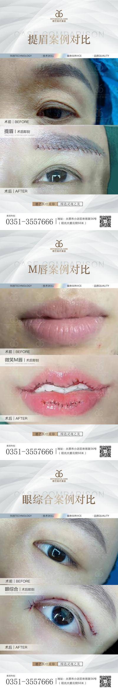 【南门网dcpsd.com】海报 医美 案例 对比图 项目 简约