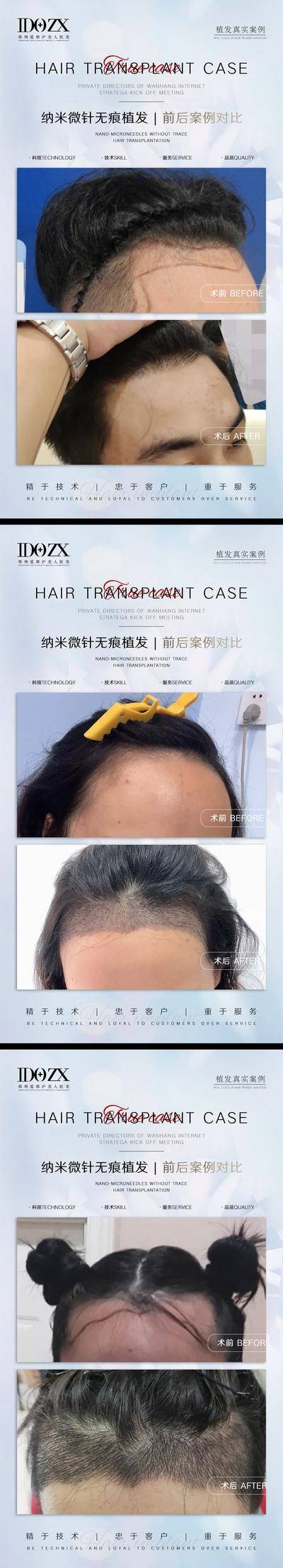 【南门网dcpsd.com】海报 医美 整形 案例 对比 植发