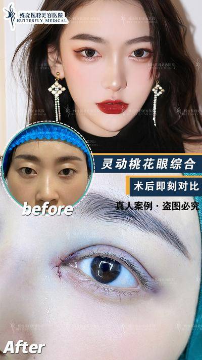 【南门网dcpsd.com】海报 医美 眼综合 案例 对比图