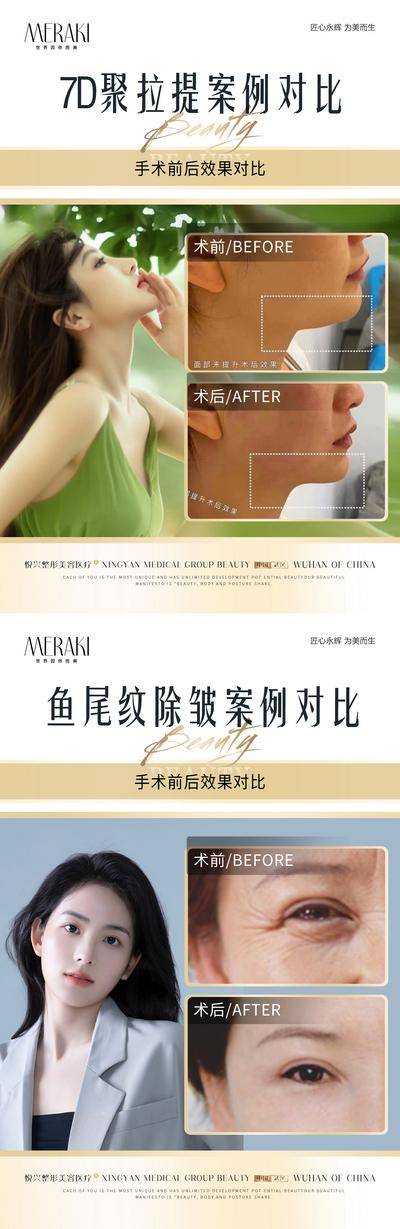 【南门网dcpsd.com】海报 医美 整形 案例 对比 人物 7D聚拉提 7D 除皱 系列