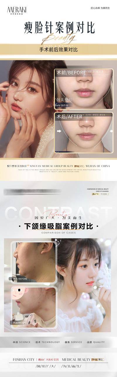 【南门网dcpsd.com】海报 医美 整形 案例 对比 人物 瘦脸针 下颌缘 吸脂