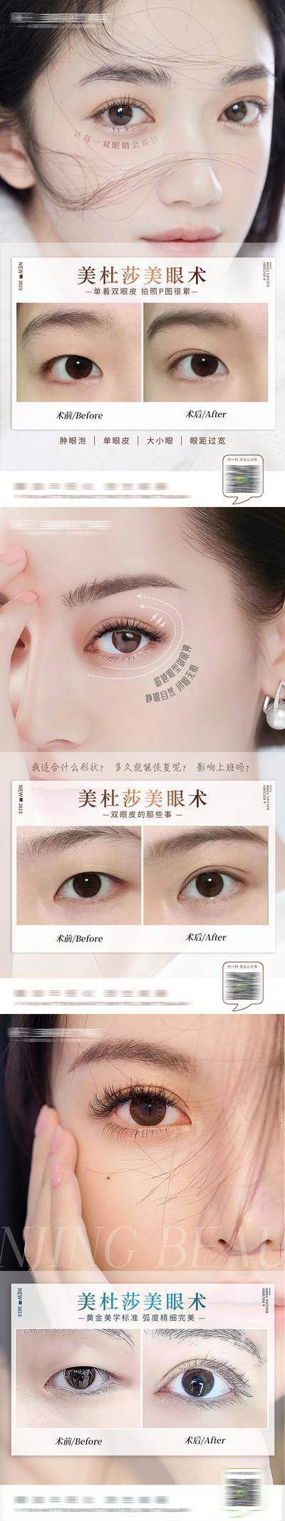【南门网dcpsd.com】海报 医美 案例对比 双眼皮案例 模特 系列