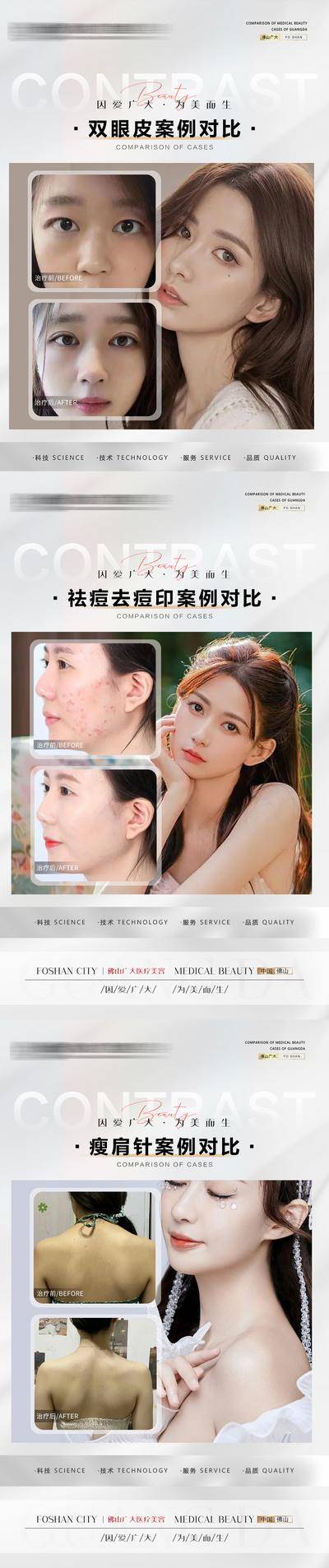 【南门网dcpsd.com】海报 医美 整形 案例 对比 人物 双眼皮 祛痘 瘦肩针 系列