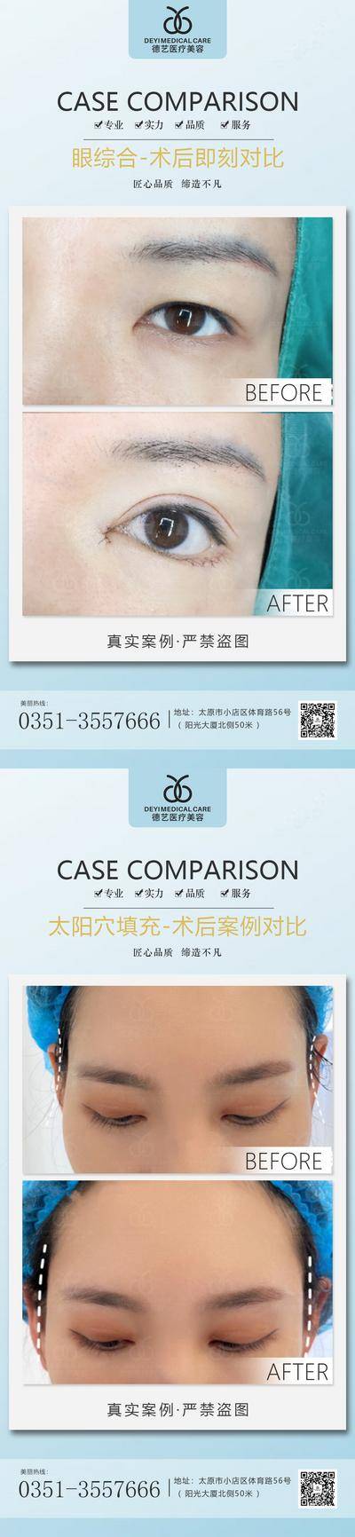 【南门网dcpsd.com】海报 医美 整形 双眼皮 太阳穴 填充 案例