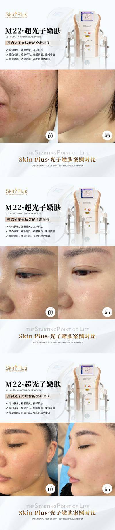 【南门网dcpsd.com】海报 医美 整形 M22 超光子嫩肤 案例 对比