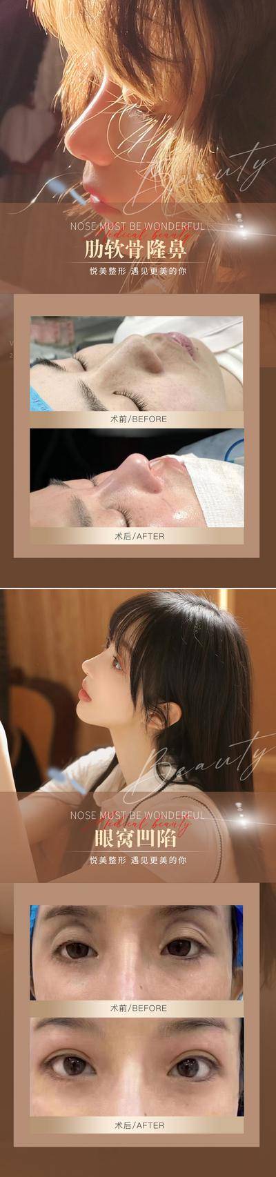 【南门网dcpsd.com】海报 医美 整形 案例 对比 隆鼻 双眼皮 系列