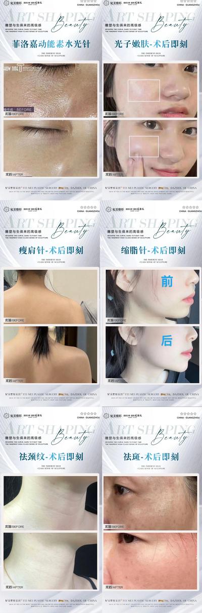 【南门网dcpsd.com】海报 医美 皮肤 真人案例 分享集 菲洛嘉动能素 水光针 光子嫩肤 瘦肩针 祛斑 缩脂针 祛颈纹 对比图 