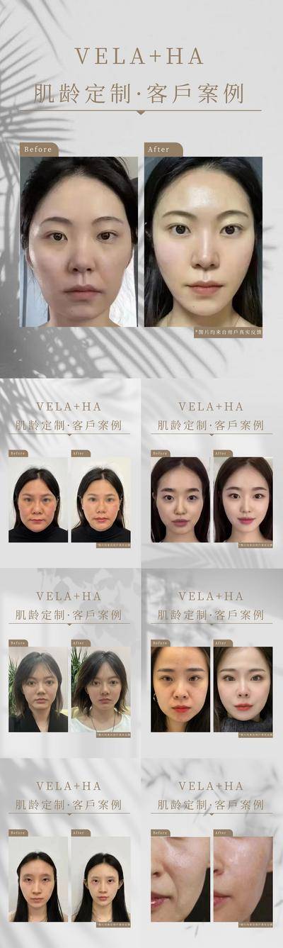 【南门网dcpsd.com】海报 医美 美业 美容  抗衰 案例 灰色 光影  简洁