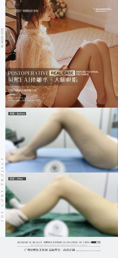 【南门网dcpsd.com】海报 医美 案例 对比 整形 瘦腿