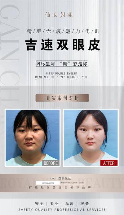 【南门网dcpsd.com】海报 医美 活动 双眼皮 对比 案例 人物