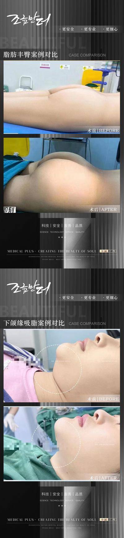 【南门网dcpsd.com】海报 医美 整形 丰臀 吸脂 下颌缘 案例 对比 系列