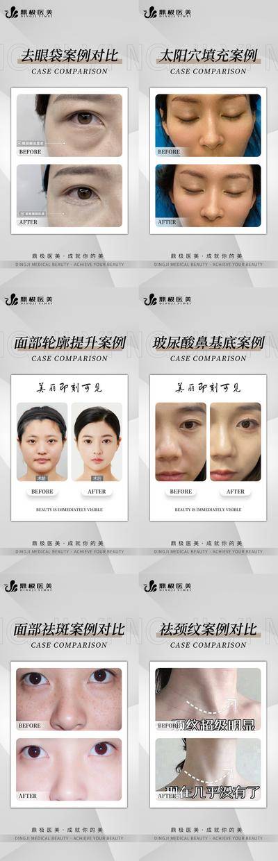 【南门网dcpsd.com】海报 医美 案例 对比 简约 人物