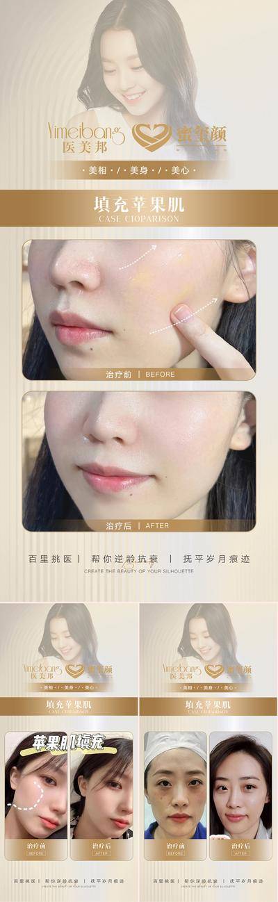 【南门网dcpsd.com】海报 医美 苹果 肌案例 对比图 简约 系列