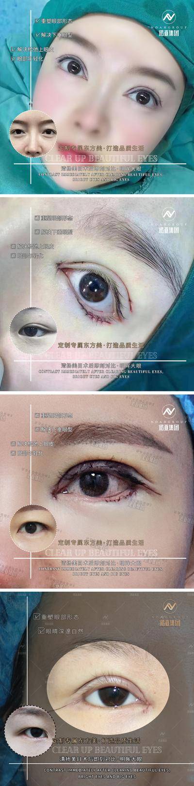【南门网dcpsd.com】海报 医美 整形 案例 对比