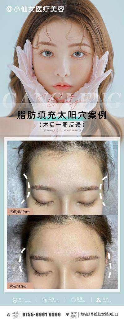 【南门网dcpsd.com】海报 长图 医美 整形 脂肪 填充 太阳穴 案例 对比 简约 人物
