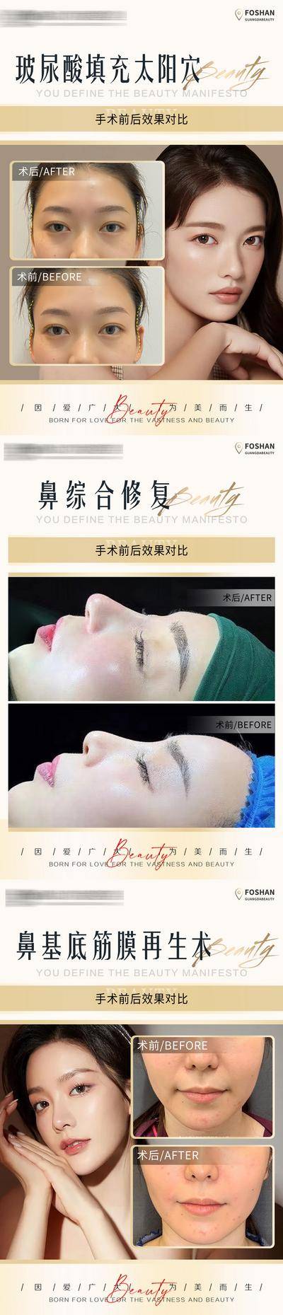 【南门网dcpsd.com】海报 医美 整形 美容 案例 对比 太阳穴 填充 鼻综合 鼻基底