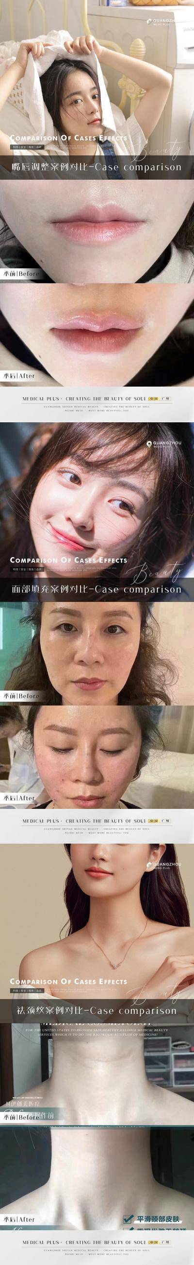 【南门网dcpsd.com】海报 医美 整形 案例 对比 人物 嘴唇 面部填充 祛颈纹 系列
