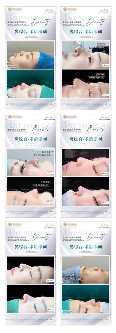 【南门网dcpsd.com】海报 医美 案例 鼻综合 整形 对比 鼻子