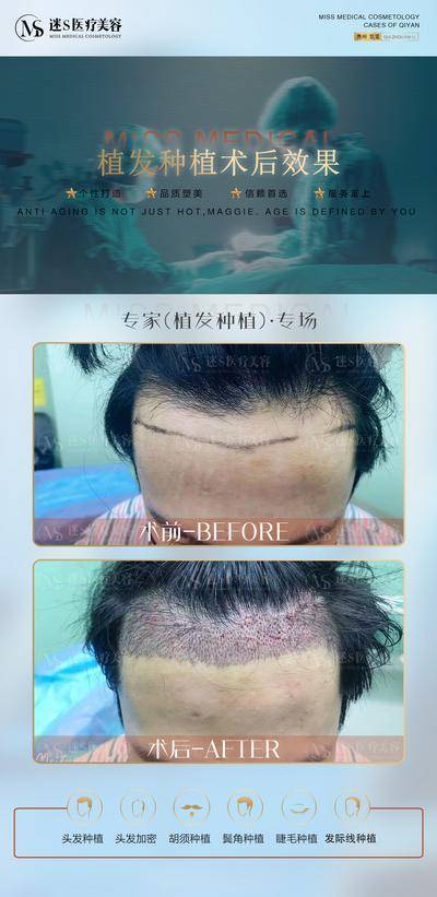 【南门网dcpsd.com】海报 医美 植发 案例 对比 简约 人物 种植 男士 女士 发际线