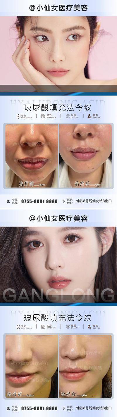 【南门网dcpsd.com】海报 医美 美容 法令纹 玻尿酸 填充 案例 对比 系列