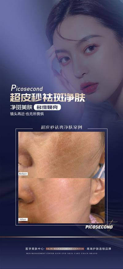 【南门网dcpsd.com】海报 医美 超皮秒 祛斑 科普 宣传 人物 案例 对比