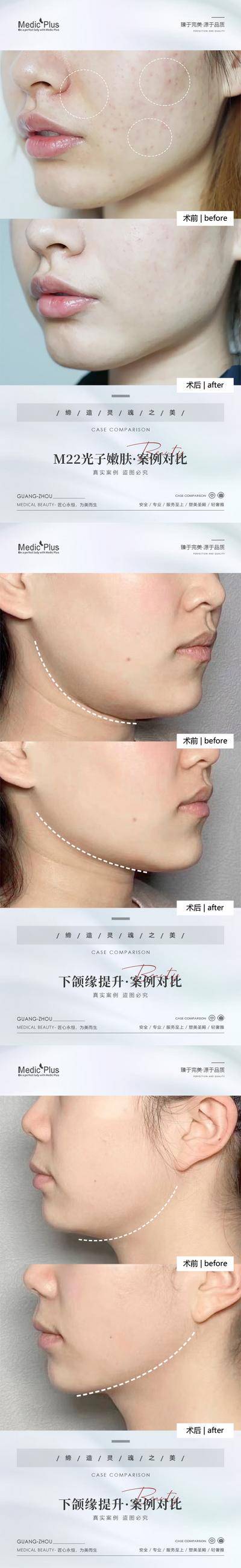 【南门网dcpsd.com】海报 医美 整形 美容 光子嫩肤 下颌缘提升 抗衰 案例 对比