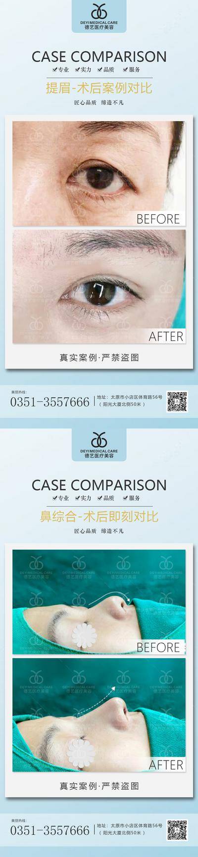 【南门网dcpsd.com】海报 医美 整形 提眉 鼻综合 案例 对比