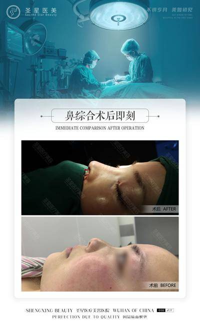 【南门网dcpsd.com】海报 医美 整形 案例 对比 鼻综合