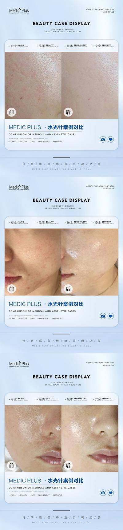 【南门网dcpsd.com】海报 医美 整形 美容 水光针 案例 前后 对比