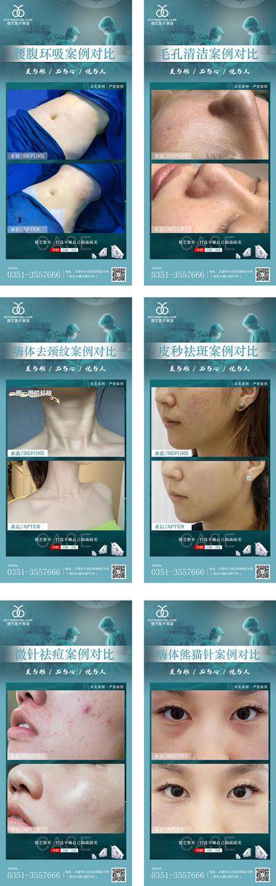 【南门网dcpsd.com】海报 医美 整形 手术 案例 对比 隆鼻 熊猫针