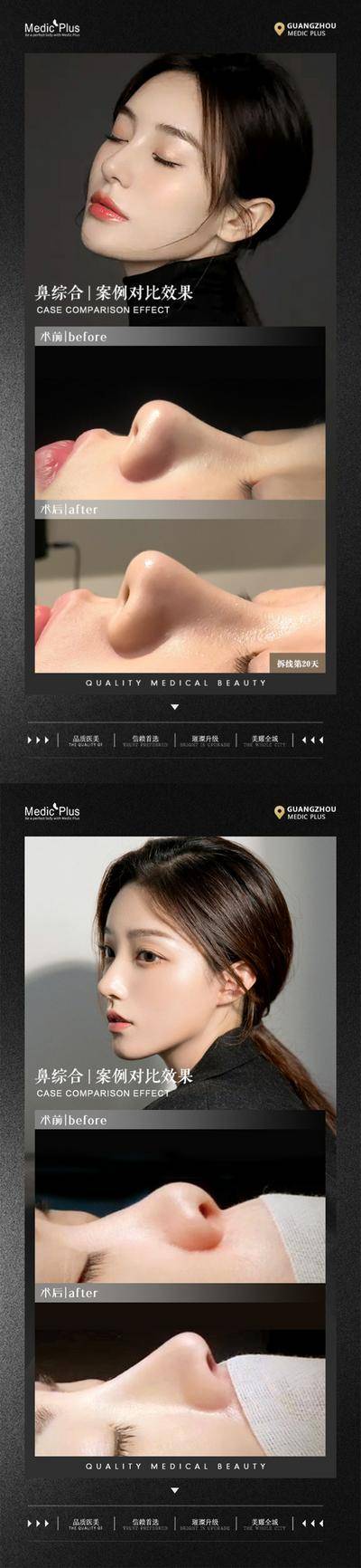 【南门网dcpsd.com】海报 医美 整形 美容 鼻综合 案例 术前术后 对比