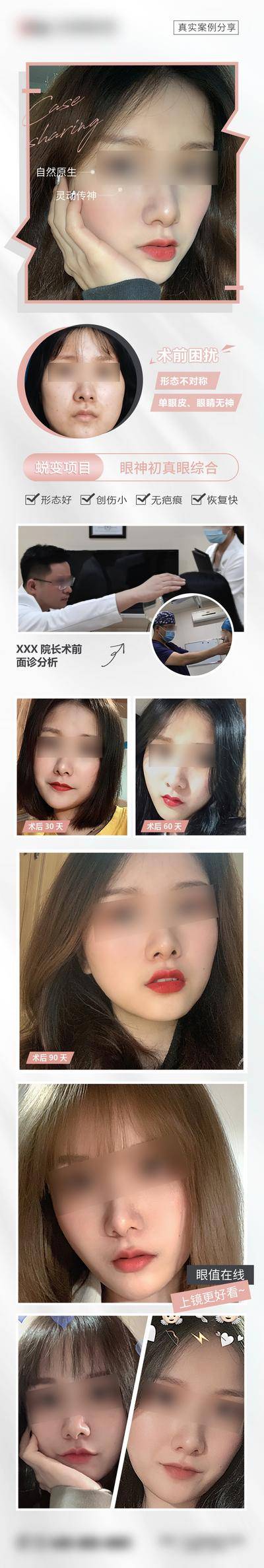 【南门网dcpsd.com】海报 长图 医美 整形 双眼皮 案例 对比 人物