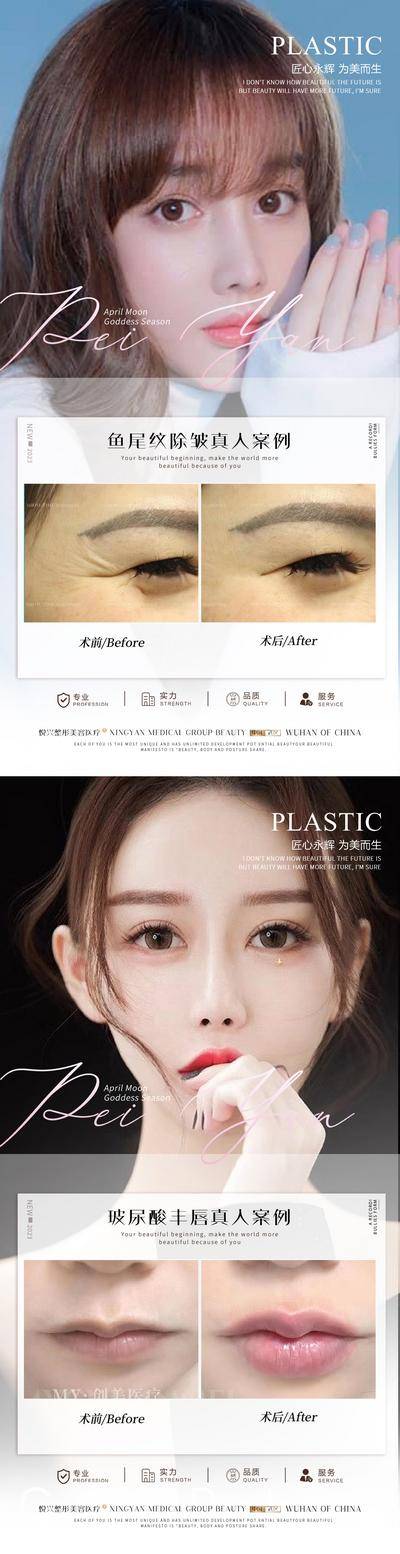 【南门网dcpsd.com】海报 医美 整形 案例 对比 鱼尾纹 除皱 玻尿酸 丰唇 系列