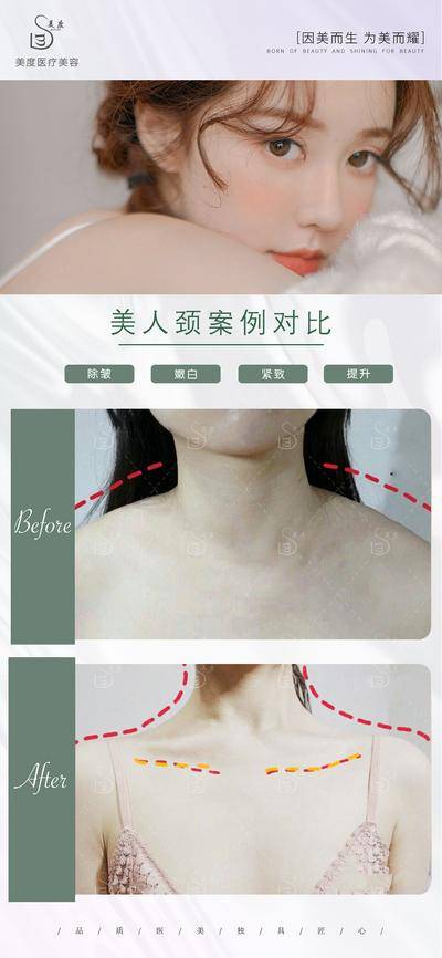 【南门网dcpsd.com】海报 医美 整形 美容 肩颈 案例 对比