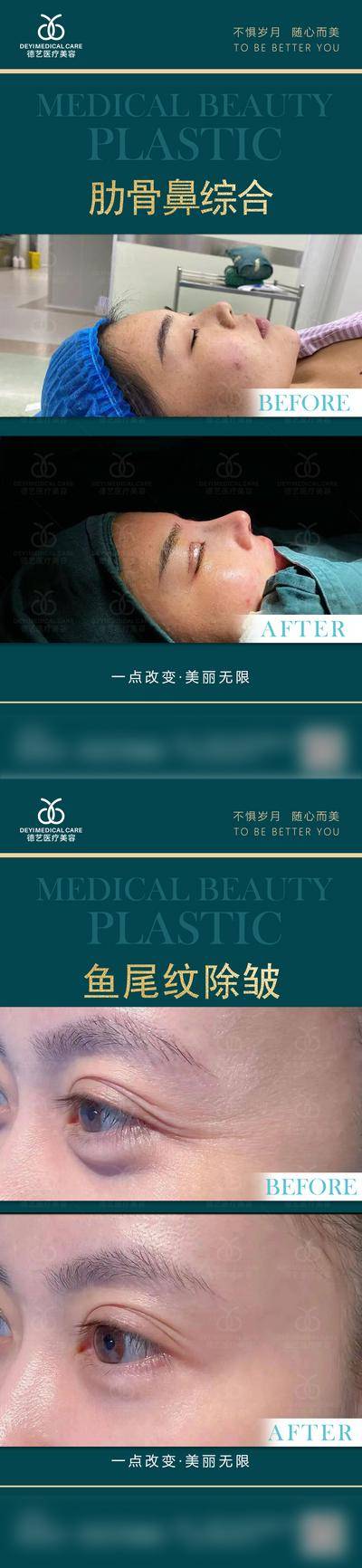 【南门网dcpsd.com】海报 医美 案例对比 除皱 模特 系列