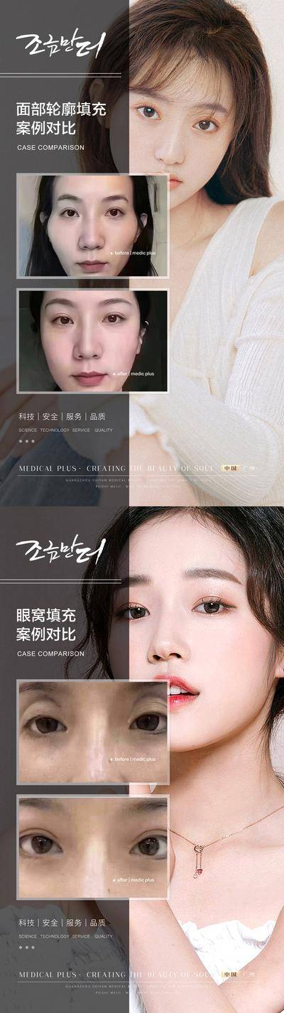 【南门网dcpsd.com】海报 医美 整形 案例 对比 面部轮廓 眼窝 填充 系列