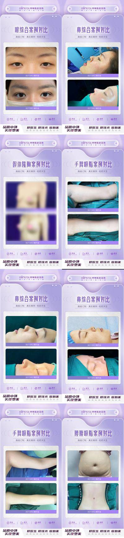 【南门网dcpsd.com】海报 医美 整形 案例 对比 项目